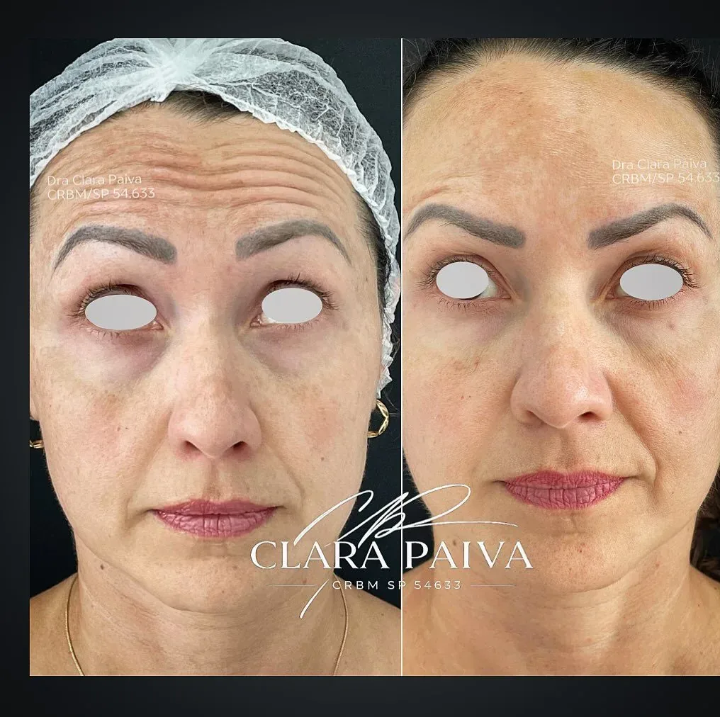 Caso clínico facial publicado pela Dra. Clara Paiva